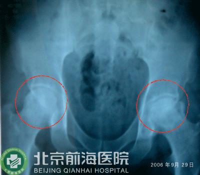 北京前海股骨头医院独创疗法让股骨头坏死不再